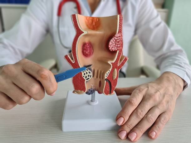 Laser Treatment for Piles: Expert Guide